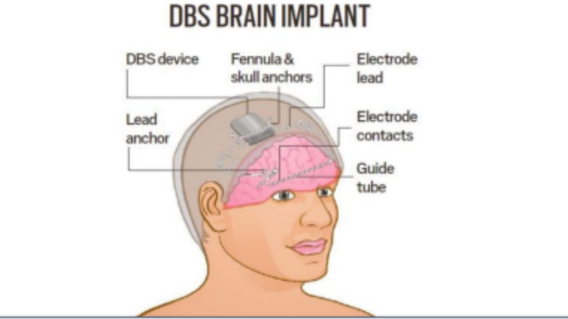 World’s First Brain Implant for Epilepsy Control